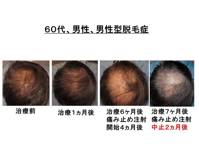 円形脱毛症　病院